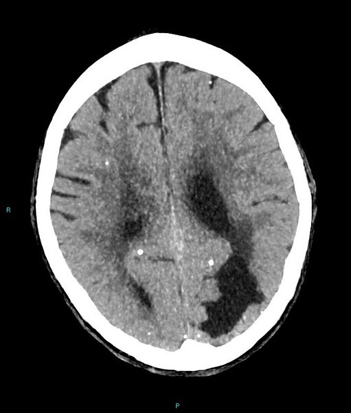 File:Calcified cerebral emboli from left ventricular thrombus (Radiopaedia 84420-99758 B 7).jpg
