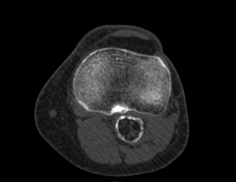 File:Calcified hematoma - popliteal fossa (Radiopaedia 63938-72763 Axial bone window 42).jpg