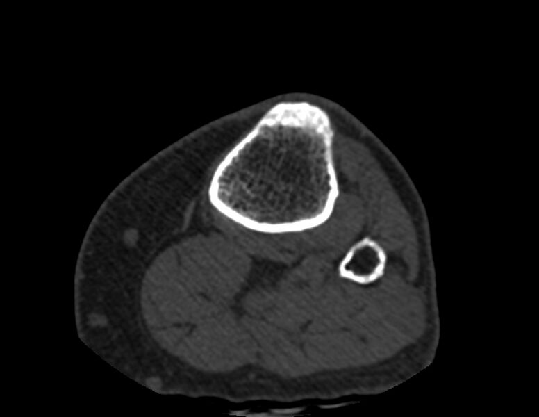 File:Calcified hematoma - popliteal fossa (Radiopaedia 63938-72763 Axial bone window 98).jpg