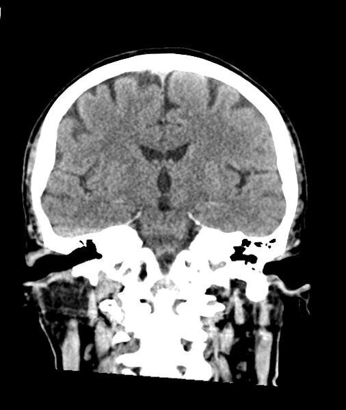 File:Calcified meningioma (Radiopaedia 74361-85243 Coronal non-contrast 29).jpg