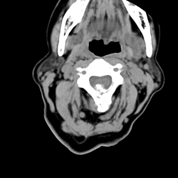 File:Calcified meningioma - cervical canal (Radiopaedia 70136-80171 B 12).jpg