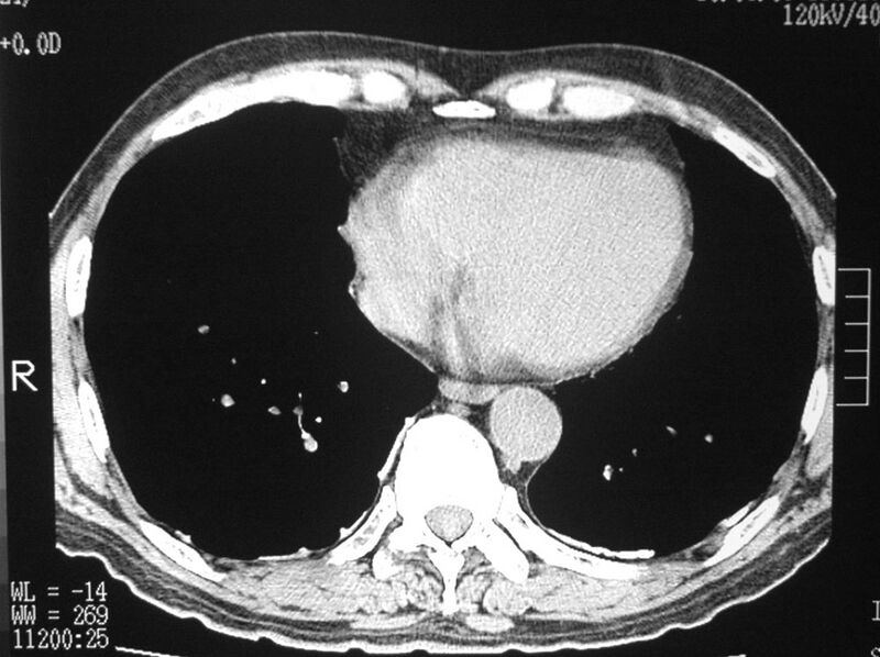 File:Calcified pleural plaques from asbestos exposure (Radiopaedia 5311-7067 Axial non-contrast 1).jpg