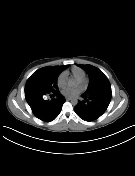 File:Calcifying pulmonary metastases (Radiopaedia 33359-34396 Axial non-contrast 17).jpg