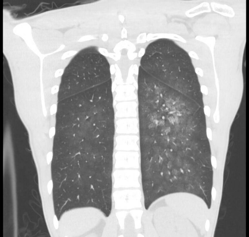 Cannabis-induced diffuse alveolar hemorrhage (Radiopaedia 89834-106946 Coronal lung window 20).jpg