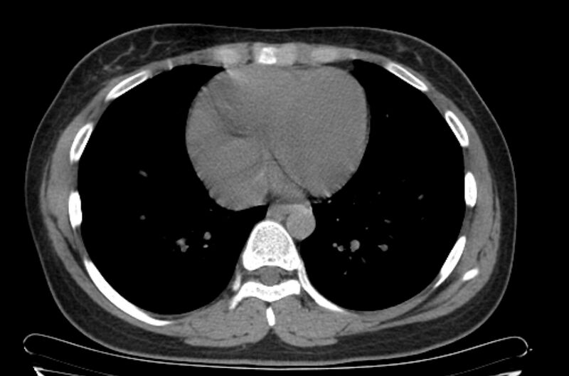 File:Cannonball metastases - uterine choriocarcinoma (Radiopaedia 70137-80173 Axial non-contrast 84).jpg