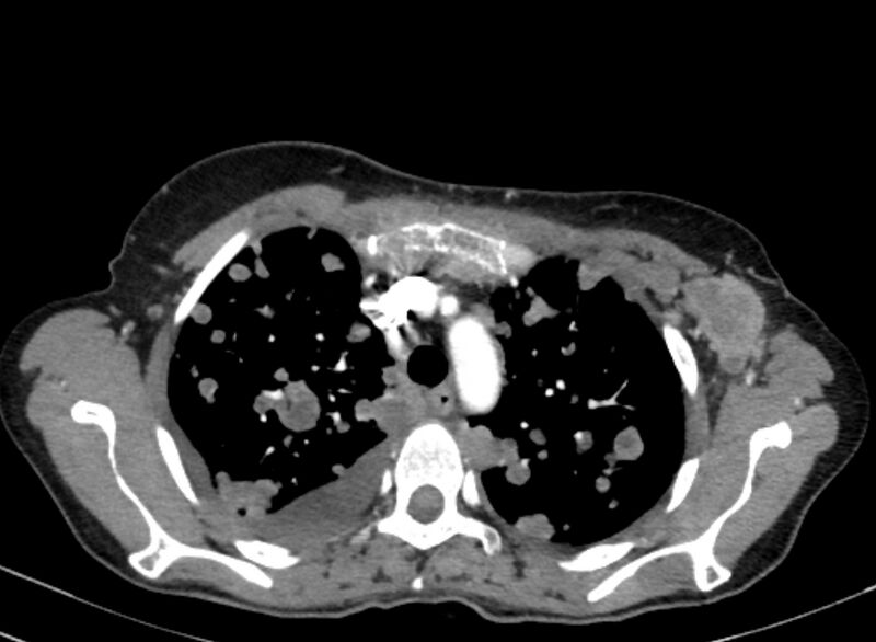 File:Cannonball metastases from breast cancer (Radiopaedia 91024-108569 A 34).jpg