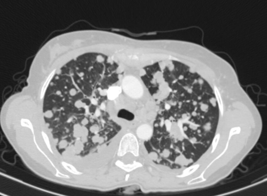 Cannonball metastases from breast cancer (Radiopaedia 91024-108569 Axial lung window 30).jpg