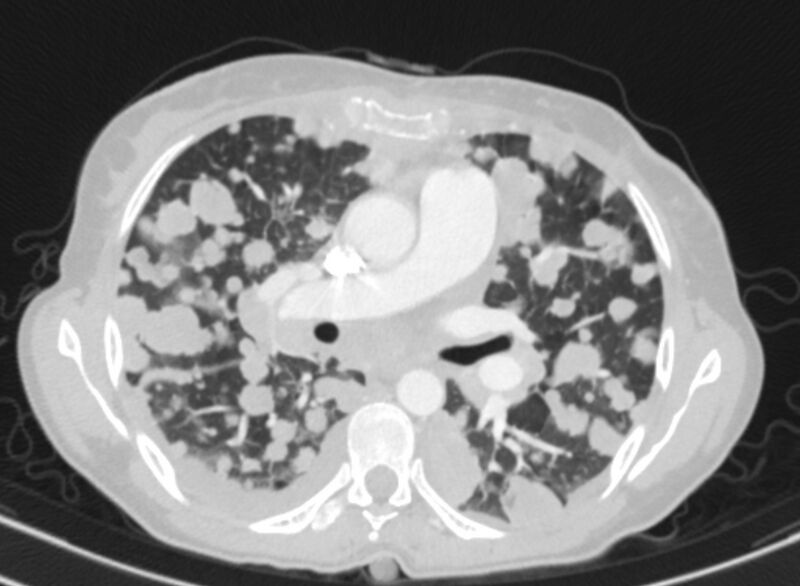 File:Cannonball metastases from breast cancer (Radiopaedia 91024-108569 Axial lung window 44).jpg