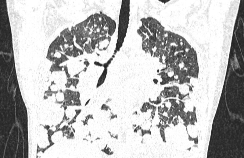 File:Cannonball metastases from breast cancer (Radiopaedia 91024-108569 Coronal lung window 78).jpg