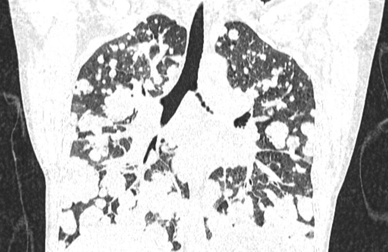 File:Cannonball metastases from breast cancer (Radiopaedia 91024-108569 Coronal lung window 82).jpg