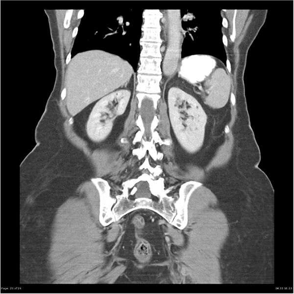 File:Carcinoid tumor of the ileum with metastasis to orbit (Radiopaedia 28165-28425 B 25).jpg