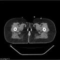 Carcinoma cervix- brachytherapy applicator (Radiopaedia 33135-34173 Axial non-contrast 61).jpg