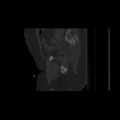 Carcinoma cervix- brachytherapy applicator (Radiopaedia 33135-34173 Sagittal bone window 43).jpg