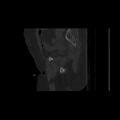 Carcinoma cervix- brachytherapy applicator (Radiopaedia 33135-34173 Sagittal bone window 47).jpg