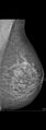 Carcinoma of left breast (Radiopaedia 28504-28746 C 1).jpg