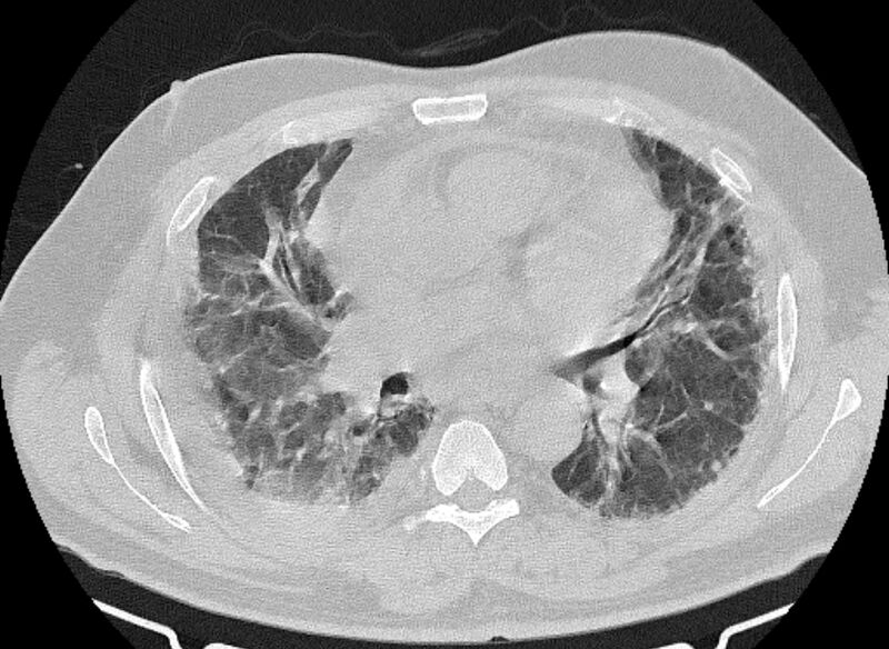 File:Cardiogenic pulmonary edema (Radiopaedia 68180-77678 Axial lung window 49).jpg