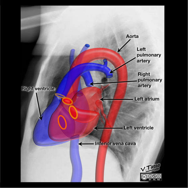 File:Cardiomediastinal anatomy on chest radiography (annotated images) (Radiopaedia 46331-50772 P 1).png