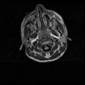 Caroticocavernous fistula (Radiopaedia 8617-9440 Axial FLAIR 1).jpg