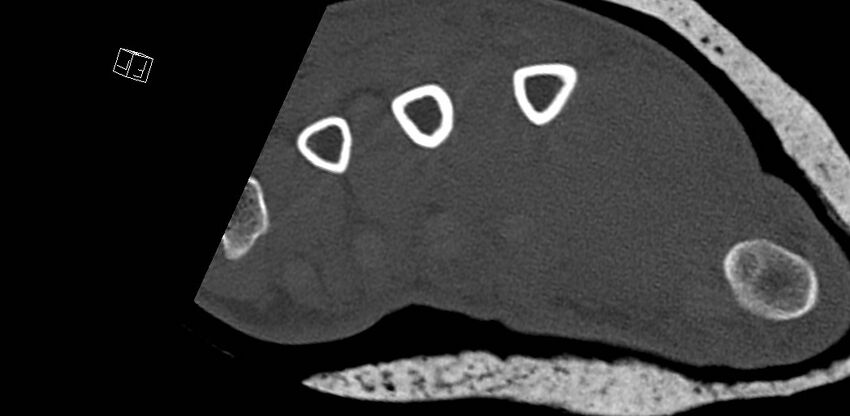 Carpal fractures (smart watch impaction) (Radiopaedia 55844-62430 Axial bone window 68).jpg