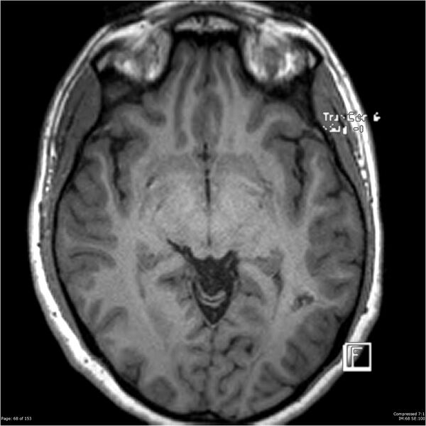File:Cavernous malformation (cavernous angioma or cavernoma) (Radiopaedia 36675-38237 Axial T1 57).jpg