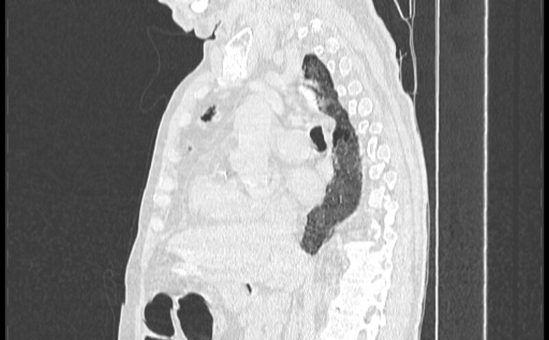 File:Cavitating bronchogenic carcinoma (Radiopaedia 44489-48162 Sagittal lung window 26).jpg