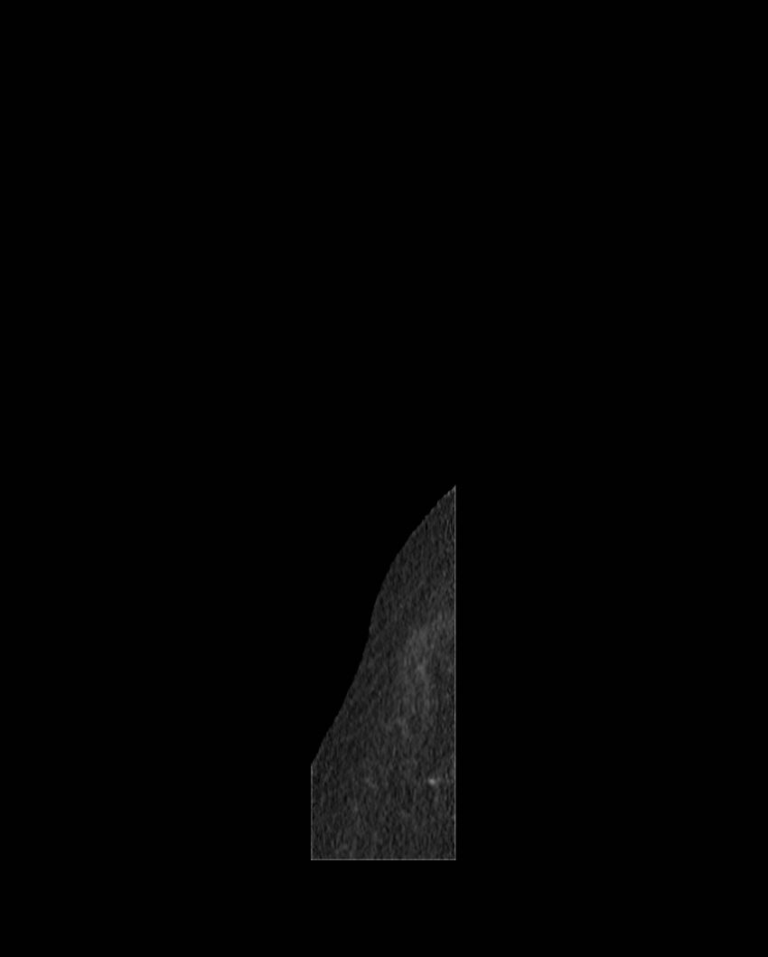 Cecal volvulus (Radiopaedia 54998-61310 C 86).jpg