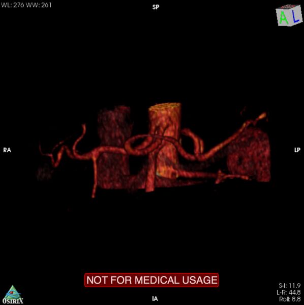 File:Celiac trunk variant anatomy - gastrohepatic trunk and splenic artery (Radiopaedia 38815-40995 B 18).jpg