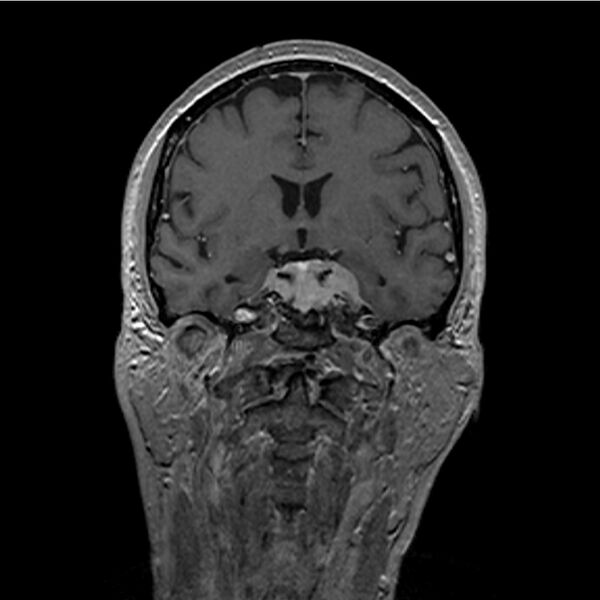 File:Central base of skull meningioma (Radiopaedia 53531-59549 Coronal T1 C+ 16).jpg