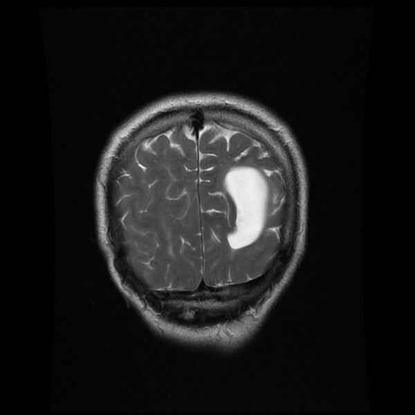 File:Central neurocytoma (Radiopaedia 67618-77021 Coronal T2 21).jpg