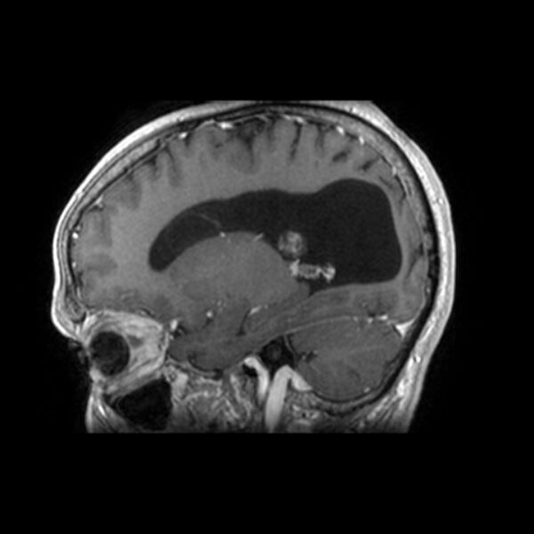 File:Central neurocytoma (Radiopaedia 67618-77021 Sagittal T1 C+ 20).jpg