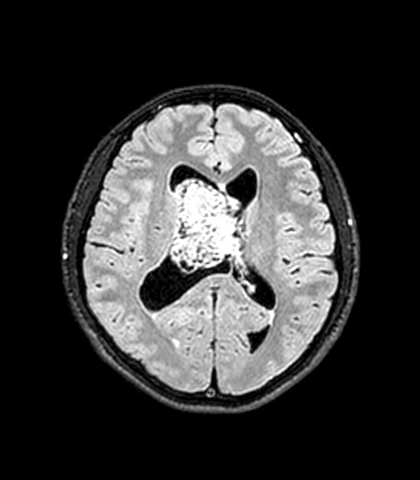 Central neurocytoma (Radiopaedia 79320-92380 Axial FLAIR 140).jpg