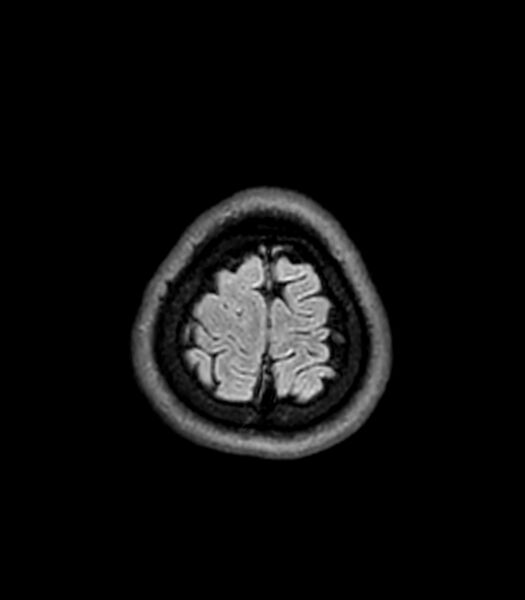 File:Central neurocytoma (Radiopaedia 79320-92380 Axial FLAIR 45).jpg