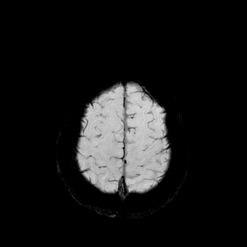 Central neurocytoma (Radiopaedia 79320-92380 Axial SWI 122).jpg