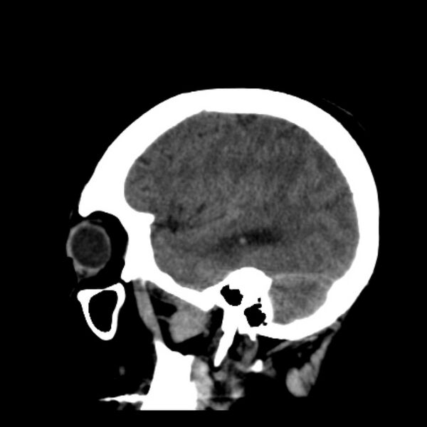 File:Cerebellar hemorrhage causing obstructive hydrocephalus (Radiopaedia 33989-35207 B 37).jpg