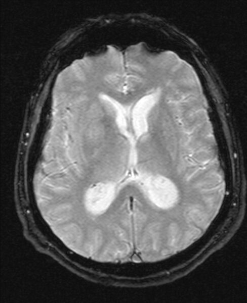 File:Cerebellopontine angle meningioma (Radiopaedia 24459-24764 Axial Gradient Echo 13).jpg