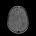Cerebral abscess post cardiac surgery (Radiopaedia 27244-27420 Axial FLAIR 17).jpg