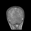 Cerebral abscess post cardiac surgery (Radiopaedia 27244-27420 Coronal T1 C+ 19).jpg
