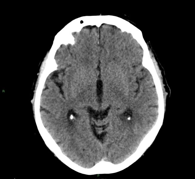File:Cerebral amyloid angiopathy-associated lobar intracerebral hemorrhage (Radiopaedia 58376-65511 Axial non-contrast 33).jpg