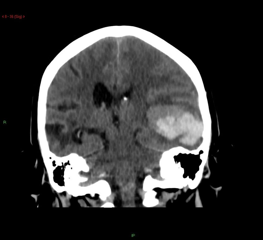 Cerebral amyloid angiopathy-associated lobar intracerebral hemorrhage (Radiopaedia 58378-65518 Coronal non-contrast 36).jpg