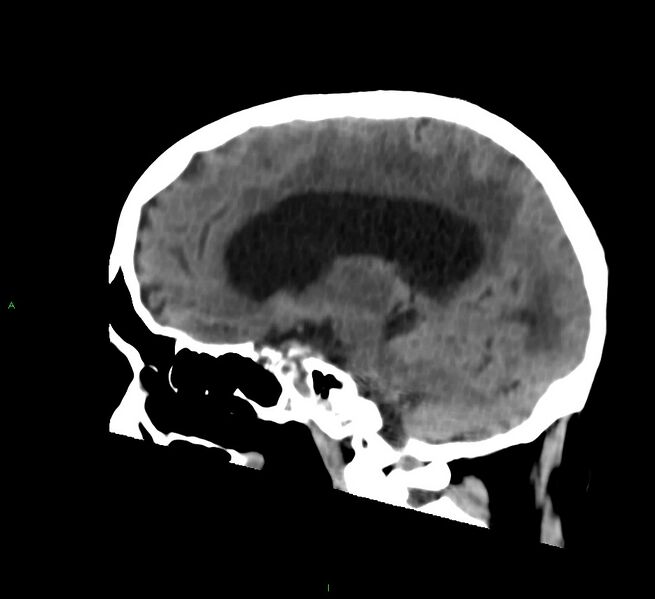 File:Cerebral amyloid angiopathy-associated lobar intracerebral hemorrhage (Radiopaedia 58530-65688 C 23).jpg