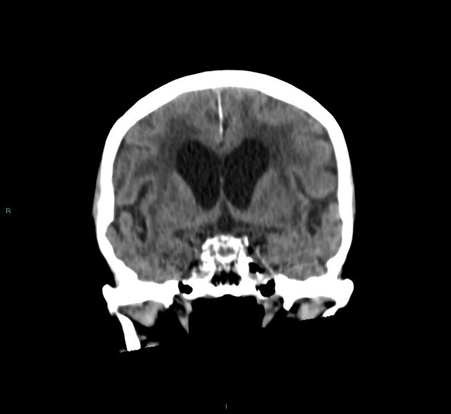File:Cerebral amyloid angiopathy-associated lobar intracerebral hemorrhage (Radiopaedia 58530-65688 Coronal non-contrast 41).jpg