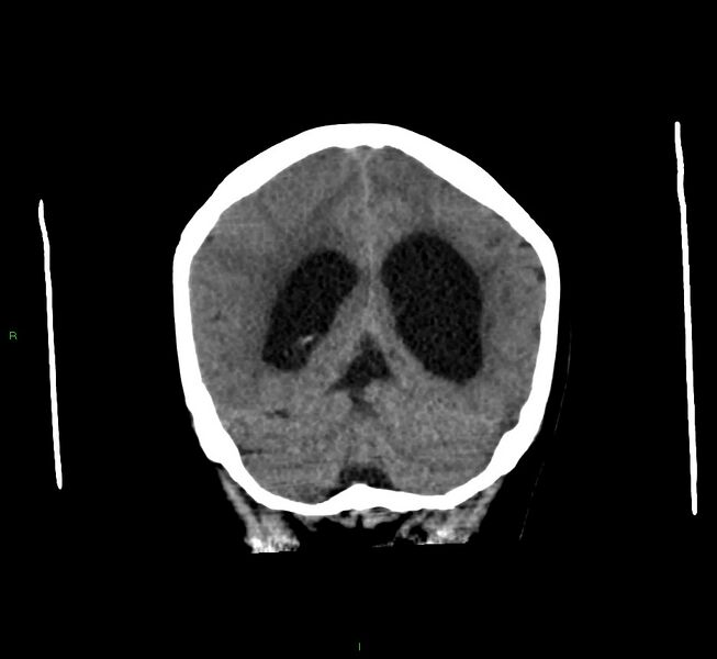File:Cerebral amyloid angiopathy-associated lobar intracerebral hemorrhage (Radiopaedia 58560-65723 Coronal non-contrast 22).jpg