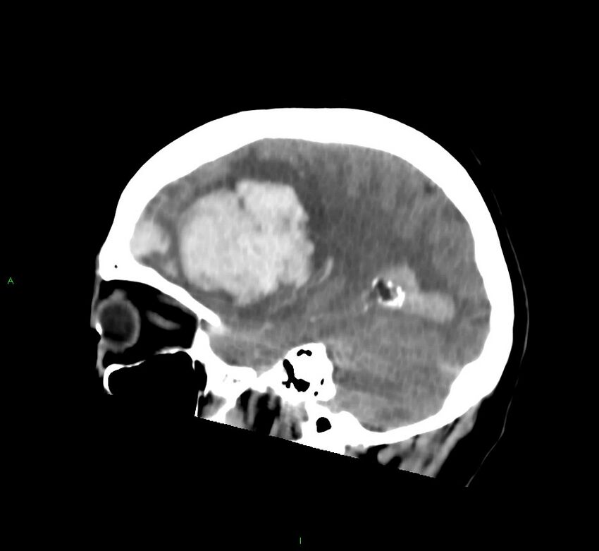 Cerebral amyloid angiopathy-associated lobar intracerebral hemorrhage (Radiopaedia 58752-65973 C 36).jpg