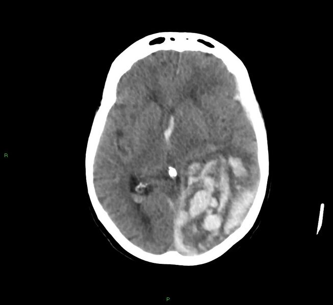 File:Cerebral amyloid angiopathy-associated lobar intracerebral hemorrhage (Radiopaedia 58754-65975 Axial non-contrast 35).jpg