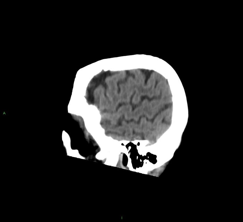 Cerebral amyloid angiopathy-associated lobar intracerebral hemorrhage (Radiopaedia 58758-65980 C 46).jpg