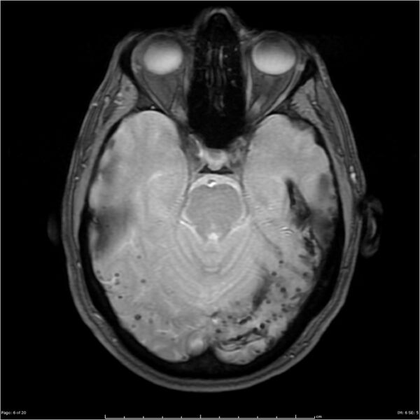 File:Cerebral amyloid angiopathy (Radiopaedia 4561-6683 Axial Gradient Echo 2).jpg