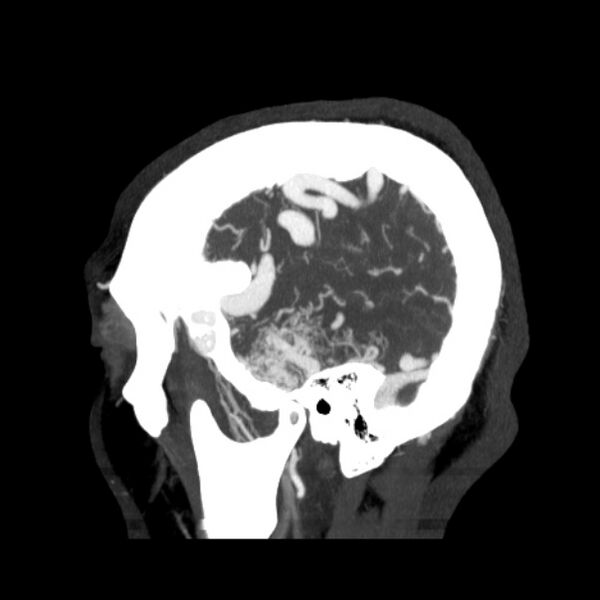 File:Cerebral arteriovenous malformation (Radiopaedia 43729-47189 D 43).jpg