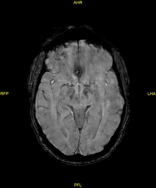 File:Cerebral autosomal dominant arteriopathy with subcortical infarcts and leukoencephalopathy (CADASIL) (Radiopaedia 86108-102054 Axial SWI 50).jpg