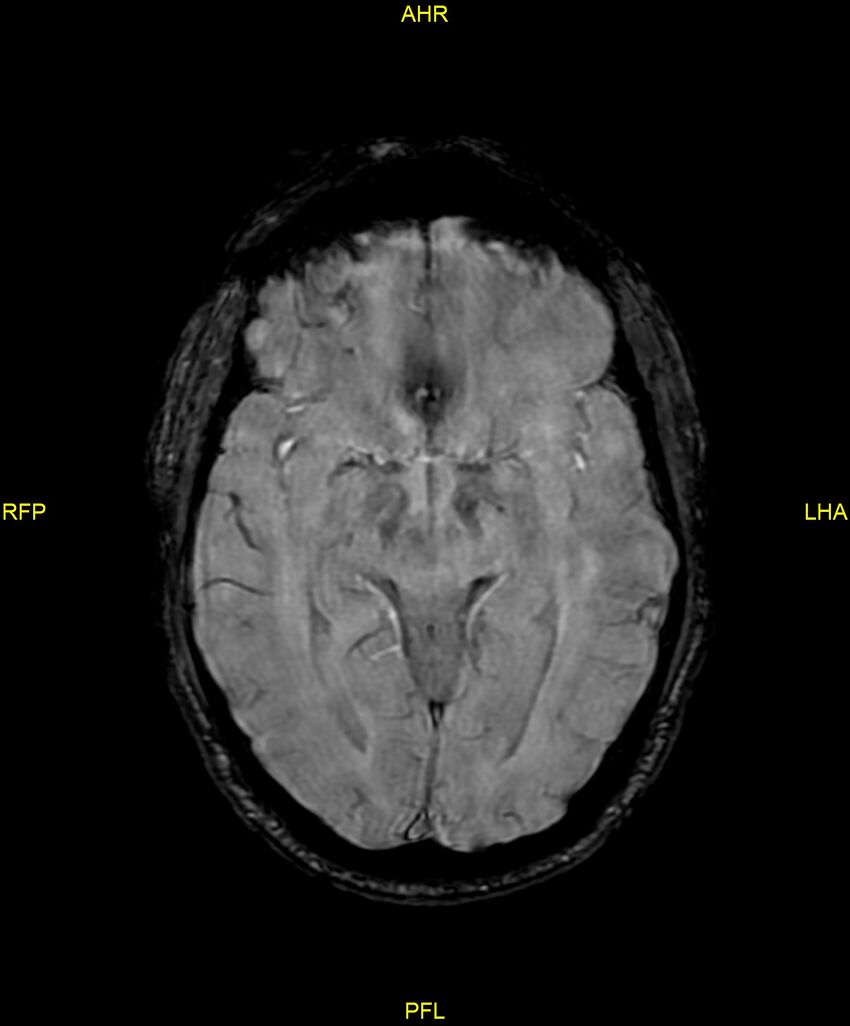 Cerebral autosomal dominant arteriopathy with subcortical infarcts and leukoencephalopathy (CADASIL) (Radiopaedia 86108-102054 Axial SWI 50).jpg