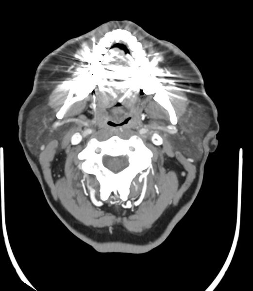 File:Cerebral dural venous sinus thrombosis (Radiopaedia 86514-102576 A 10).jpg